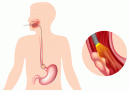 Disegno schematico di una esofagoscopia per la ricerca di un cancro all'esofago