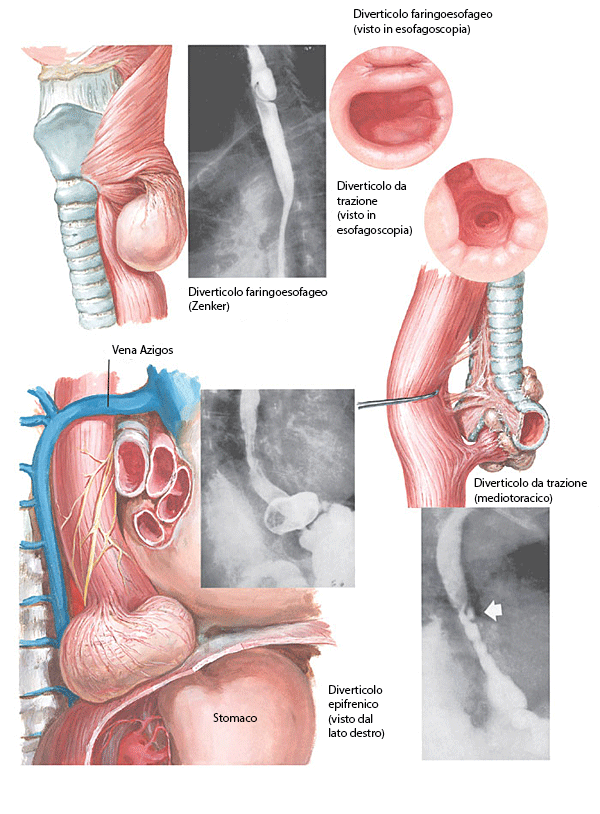 I vari tipi di diverticoli dell'esofago.